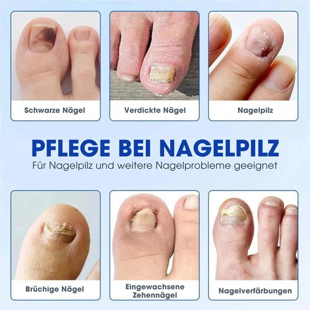 FUNGEX™ – Nagelpflaster gegen Nagelpilz